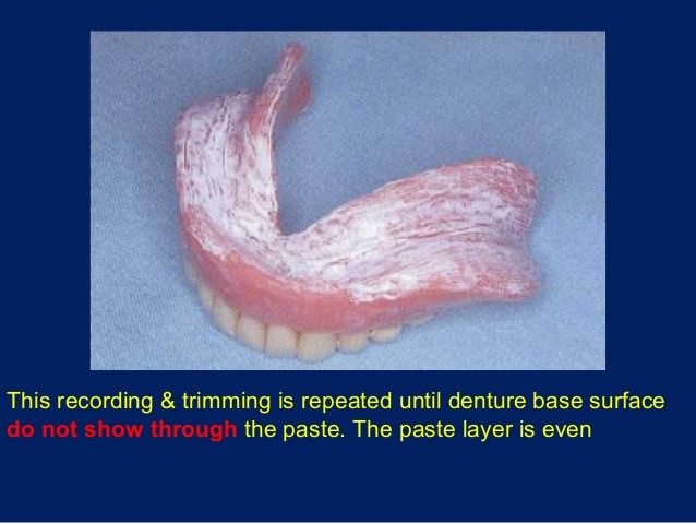 Affordable Dentures Ultimate Fit Frost MN 56033